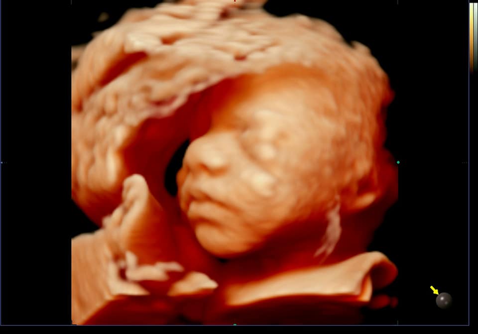 Echographie 3d Bebe Art Echo Facebook