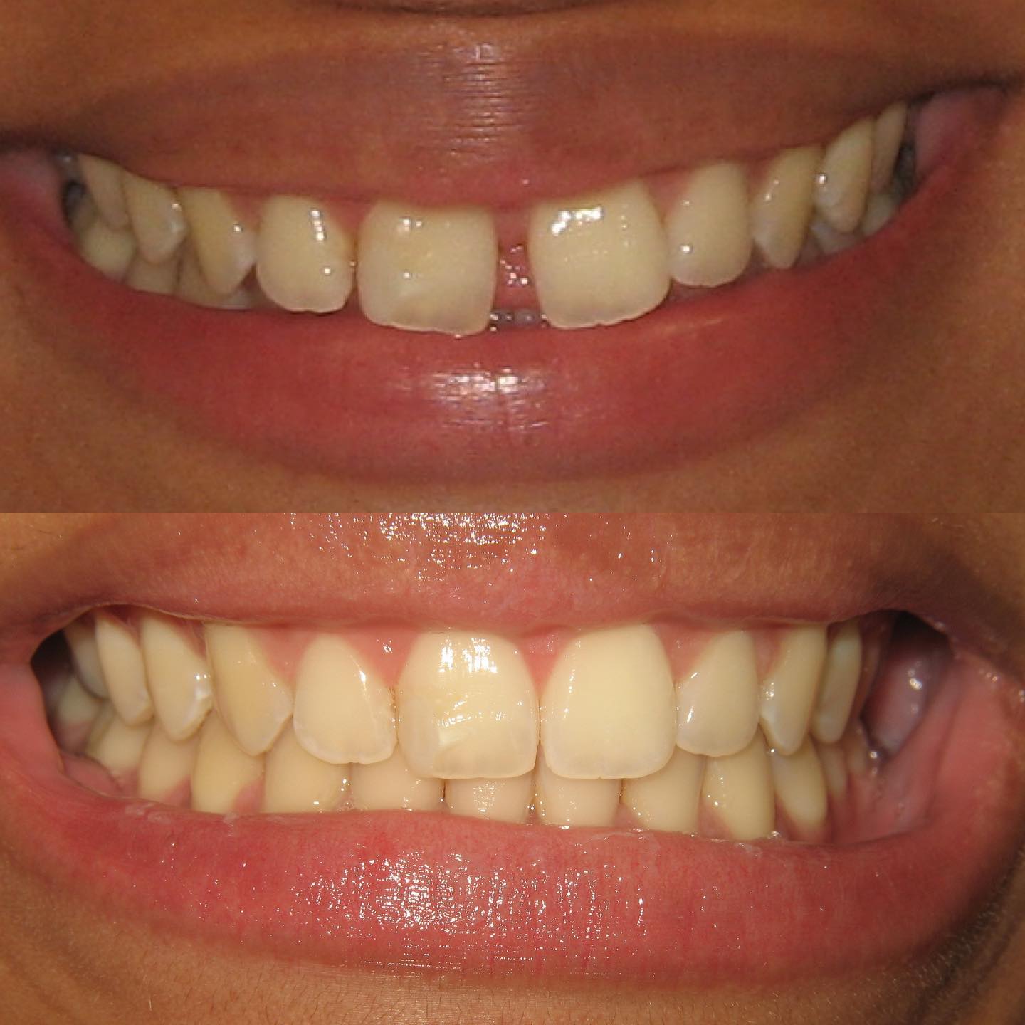 💎 THE POWER OF INVISALIGN 💎 This... - Dr. Pamela Marzban | Facebook