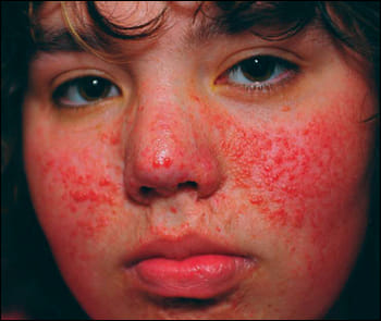 Medsea - 19-year-old woman presented with a red rash on her face. The ...
