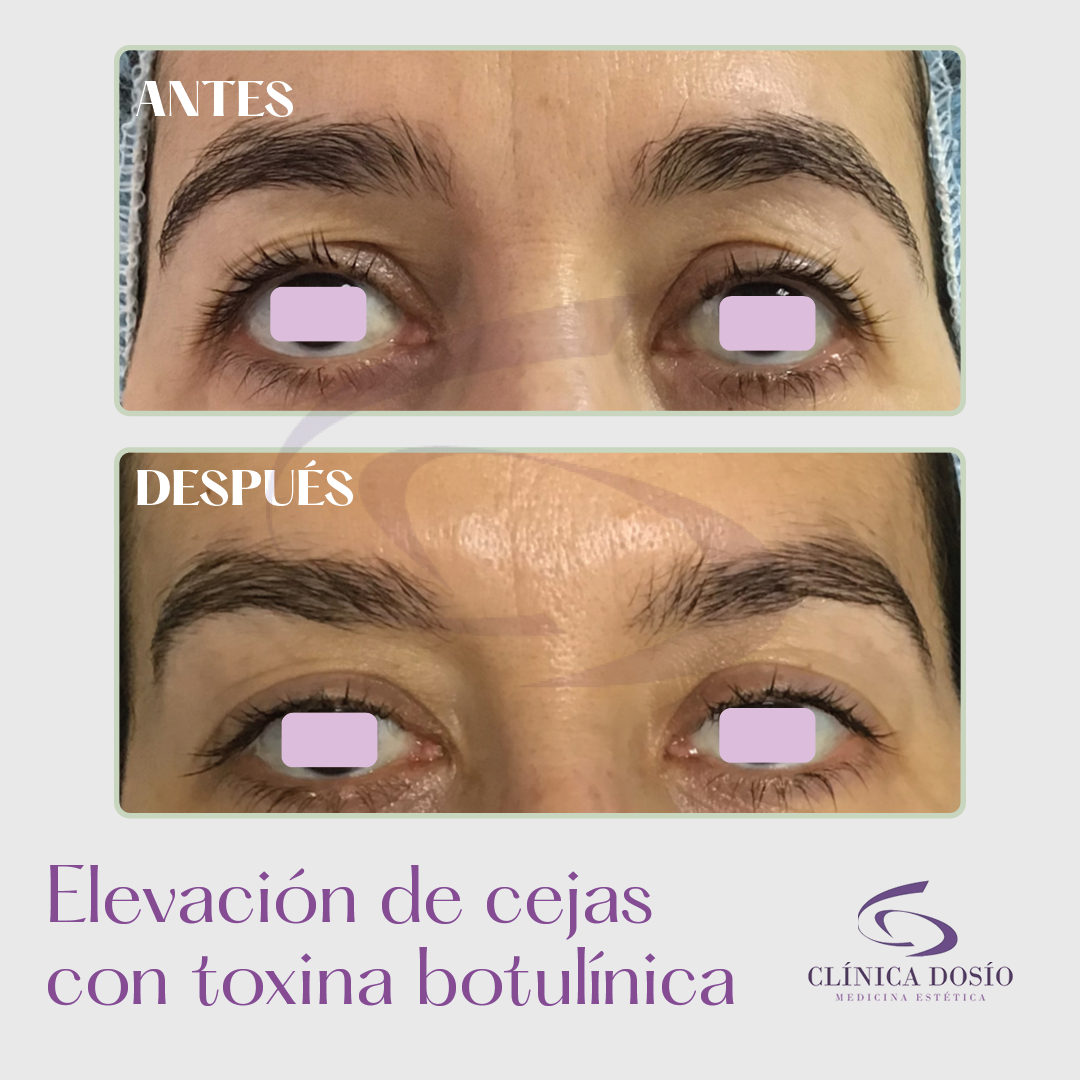 cl-nica-dos-o-toxina-botul-nica-elevaci-n-de-cejas-la-toxina