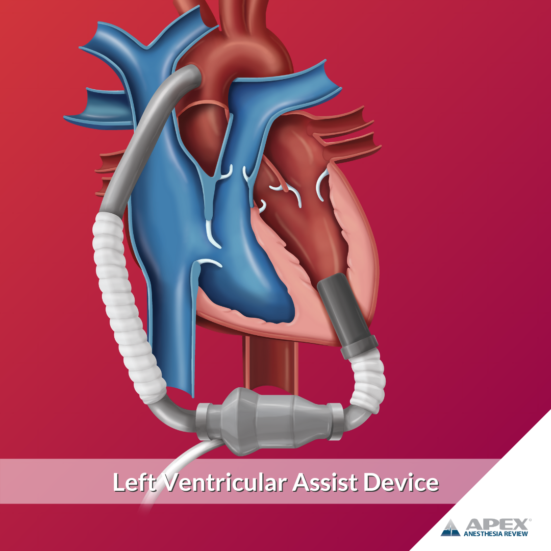 APEX Anesthesia Review - 📚 Two-Minute Anesthesia Review: Left ...