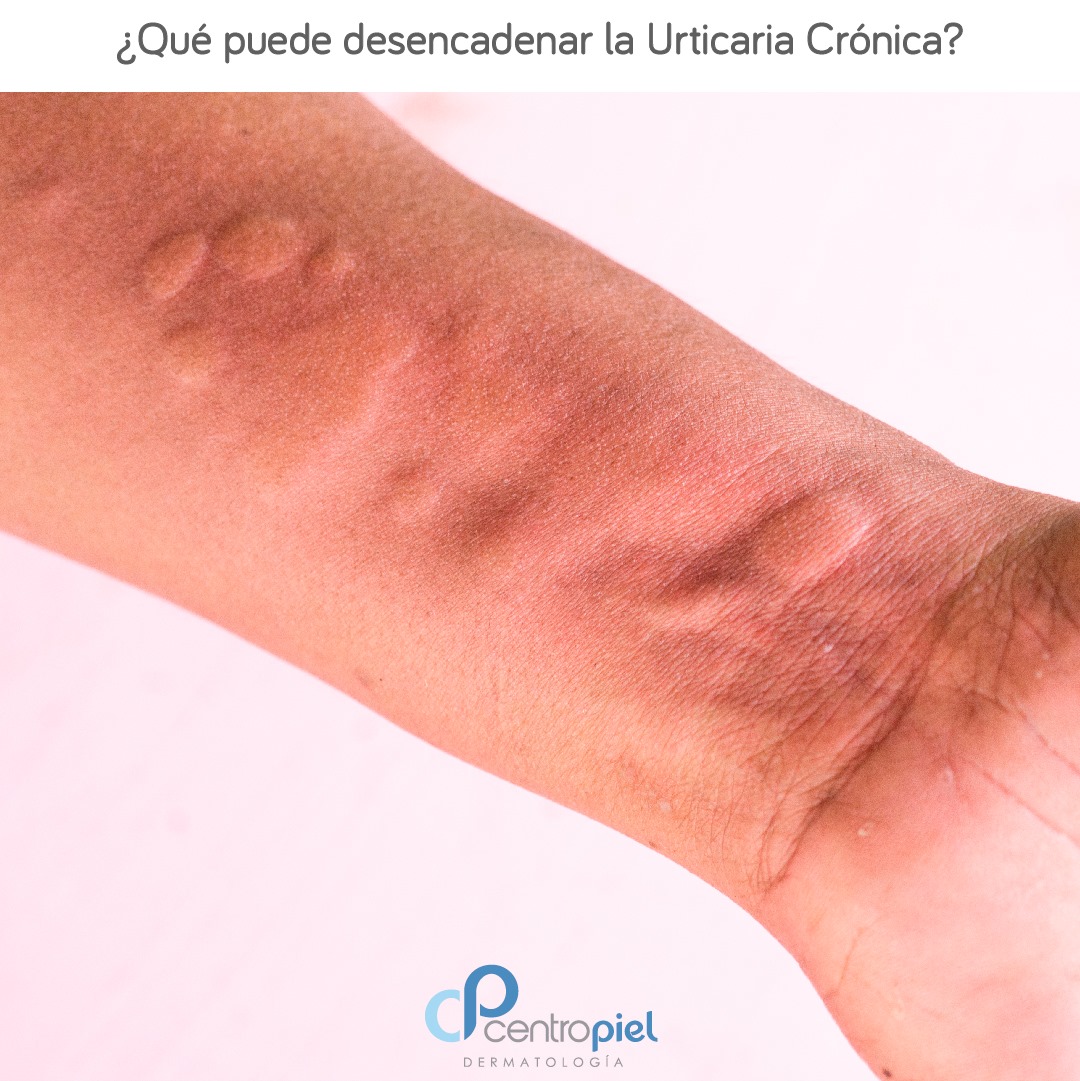 ‼️ ¿Qué puede desencadenar la... - Centro Piel Derma