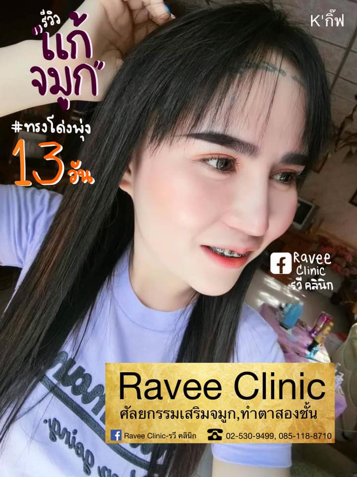 แก้จมูก👃🏻