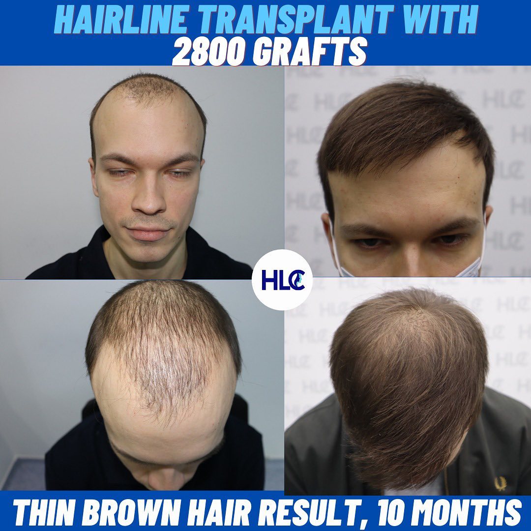 Hlc Sac Ekim 4000 Greft 12 01 2018