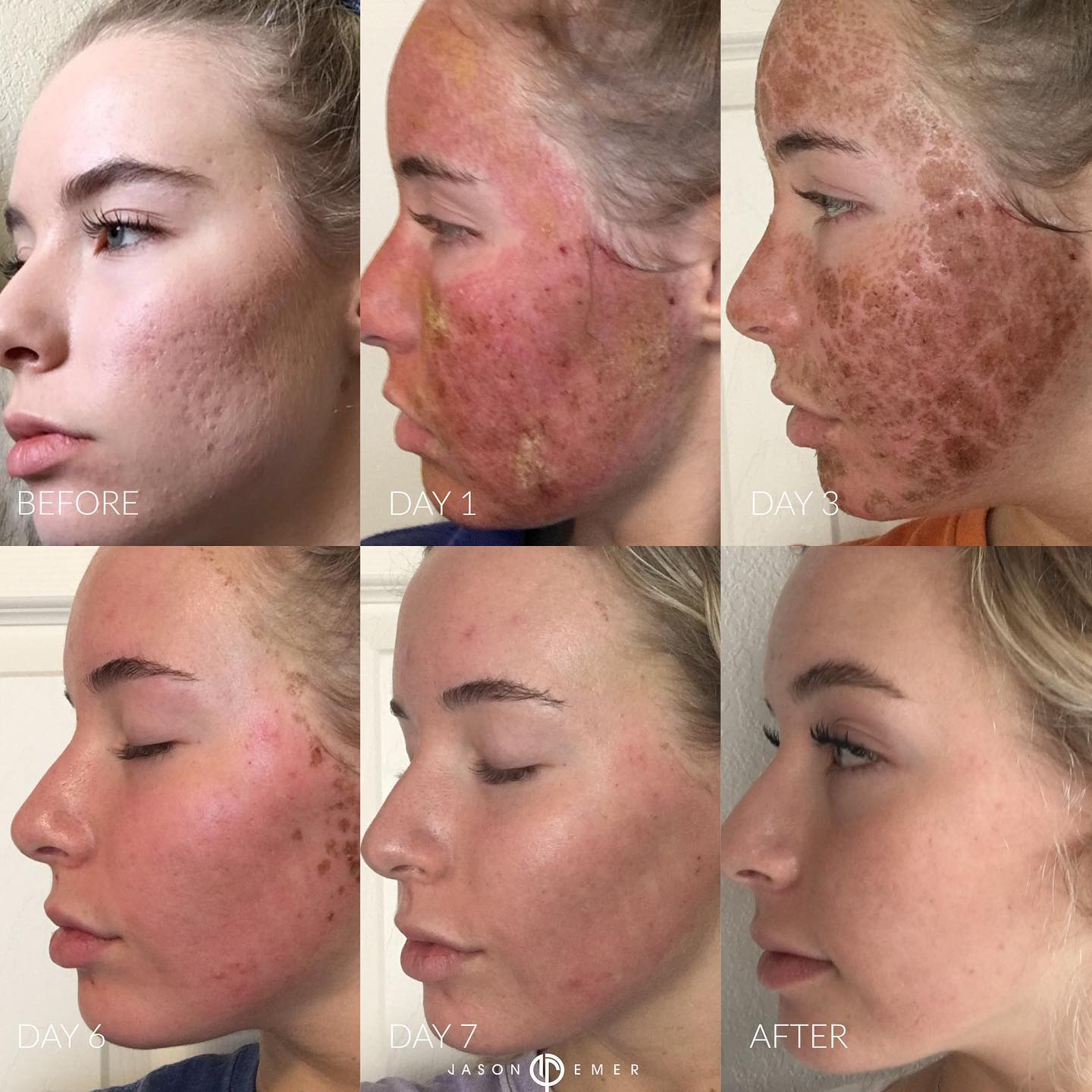 does topical ghk cu work for acne GHK-Cu vs Injection lethargic bpc 157 tb 500 Size:30 ml