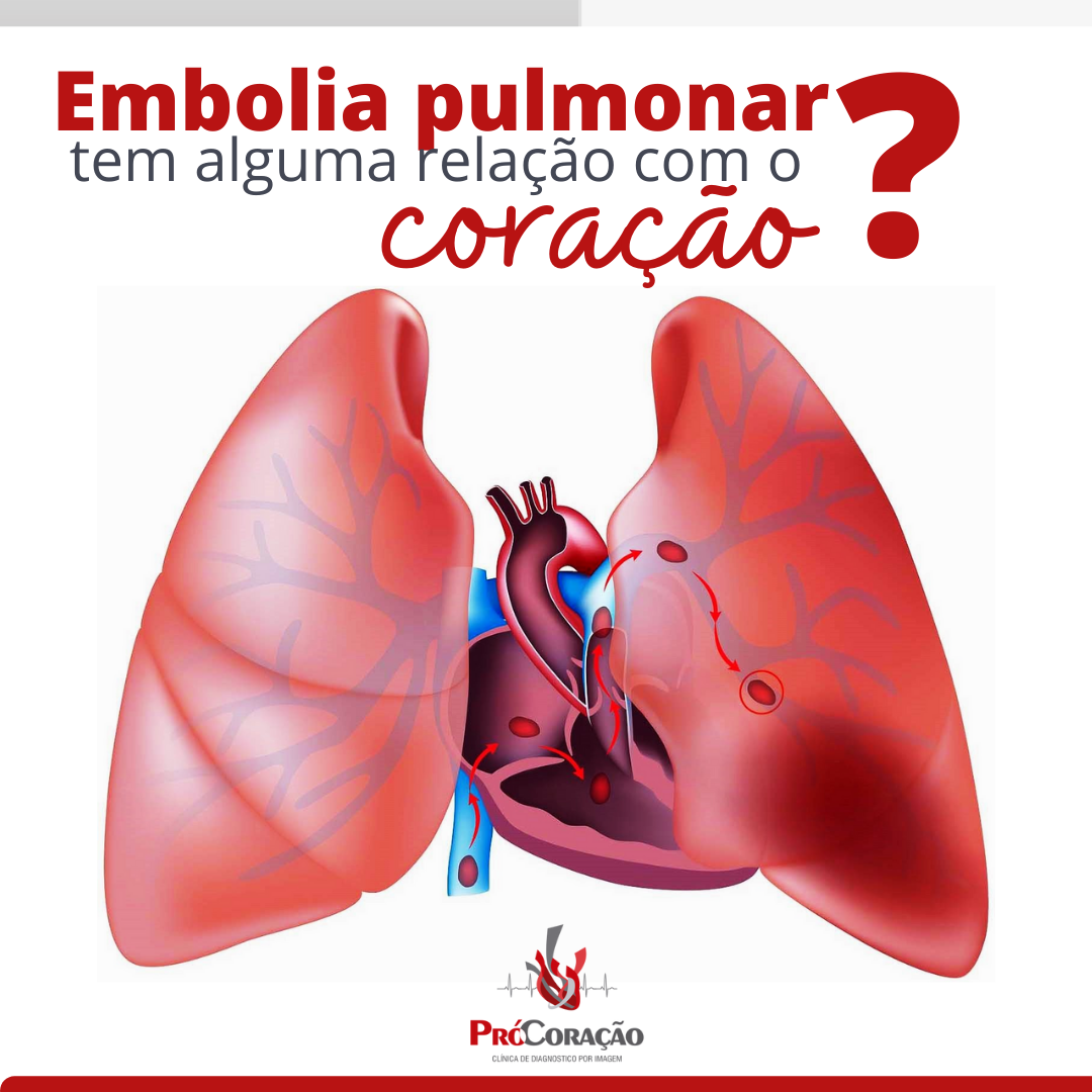 A embolia pulmonar acontece... - Procoração Serviços Médicos