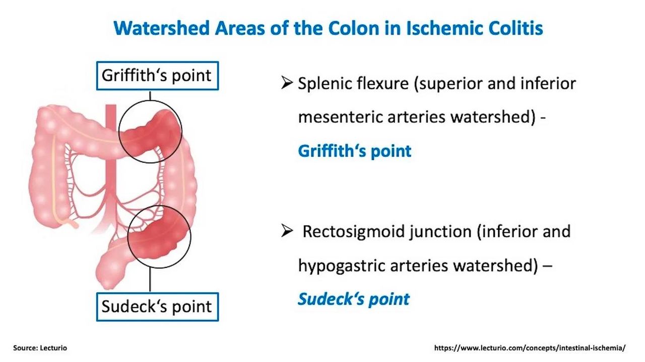 semaglutide and ischemic colitis blood in stool on Semaglutide-Associated a Patient Without Traditional Risk Factors: A Case Report Blood in Stool on Ozempic:  Ischemic colitis on colonoscopy