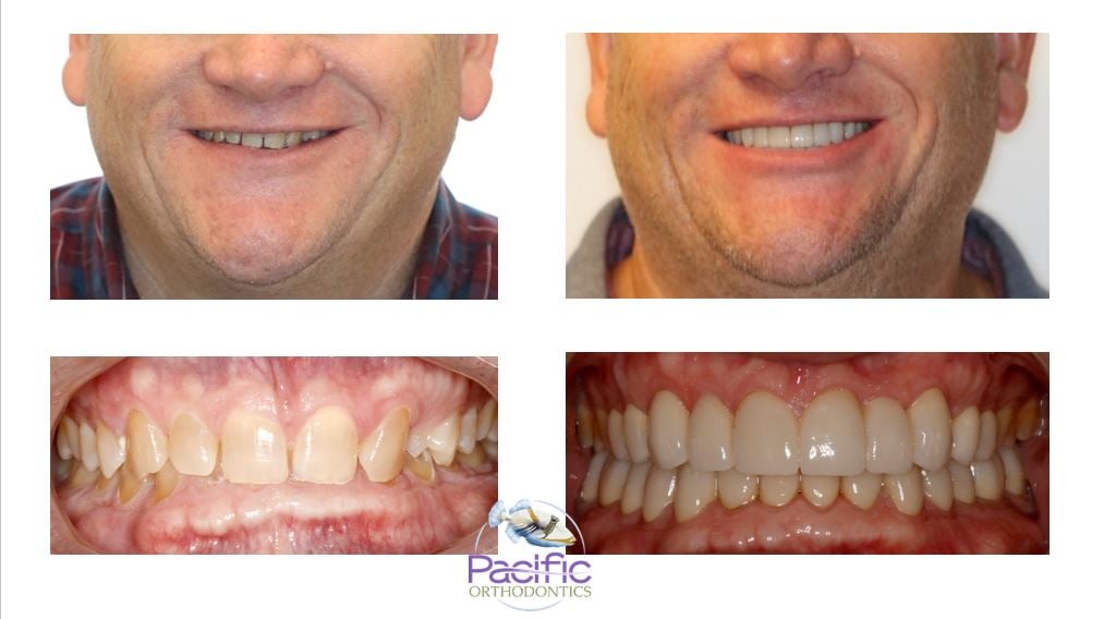 Pacific Orthodontics - Diane Doppel, DDS, MSD - Celebrating this smile ...