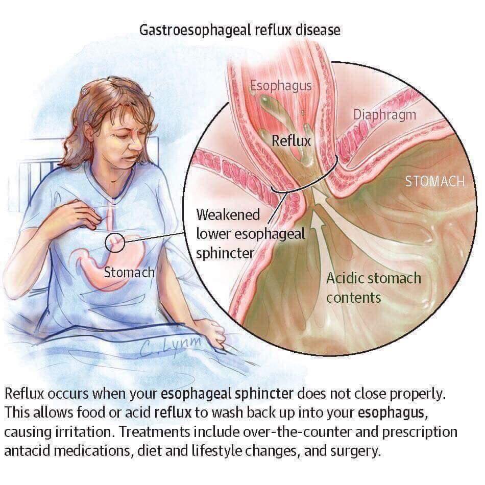 Dr Iqra Qureshi - Gastroesophageal reflux disease (GERD), also known as ...