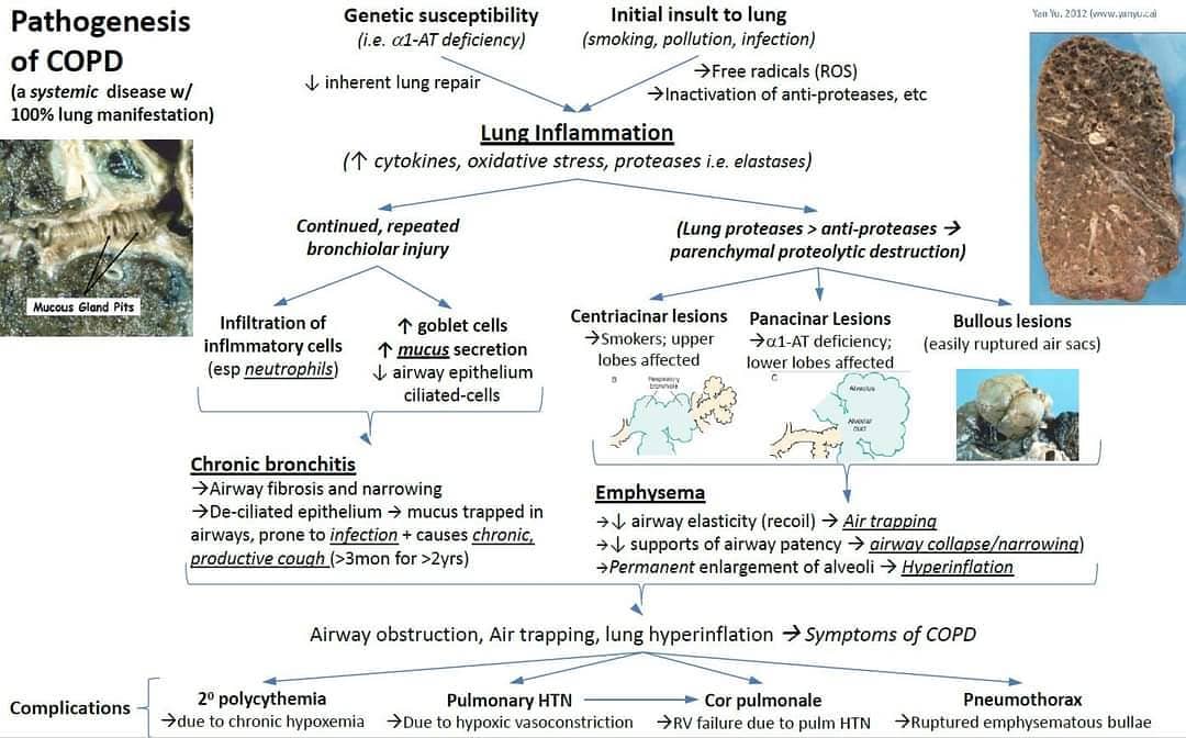 Anesthesia - Pathogenesis of COPD | Facebook