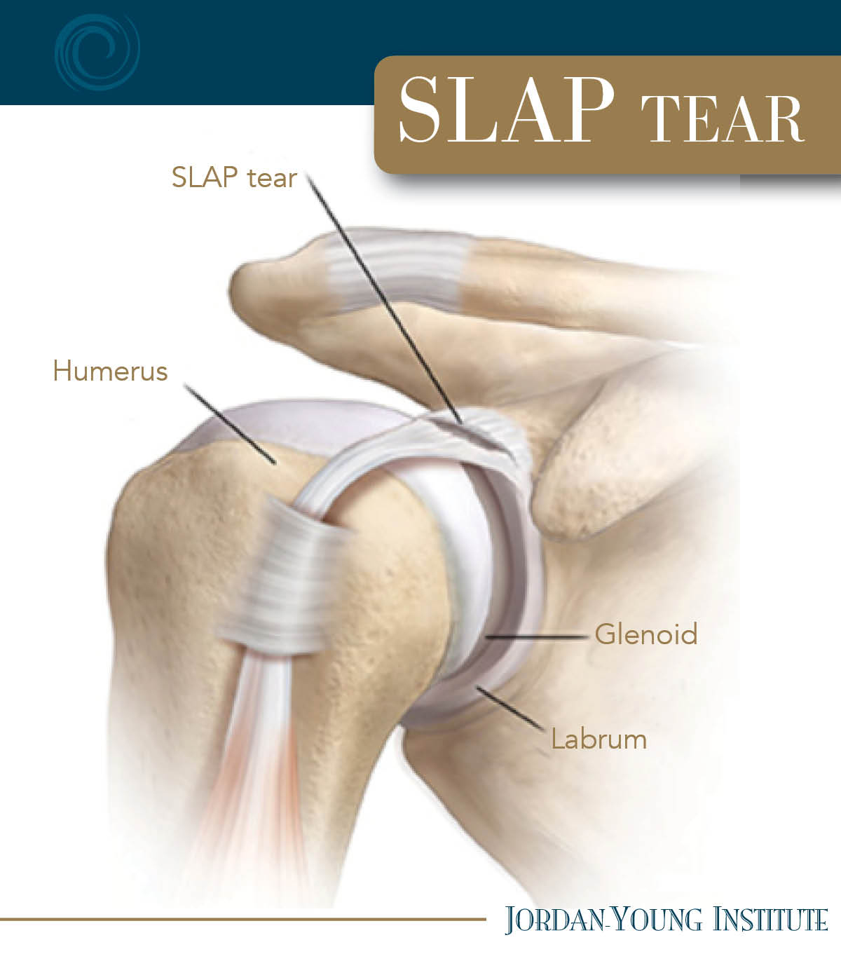 A SLAP tear is a type of shoulder injury. It affects the labrum, which ...