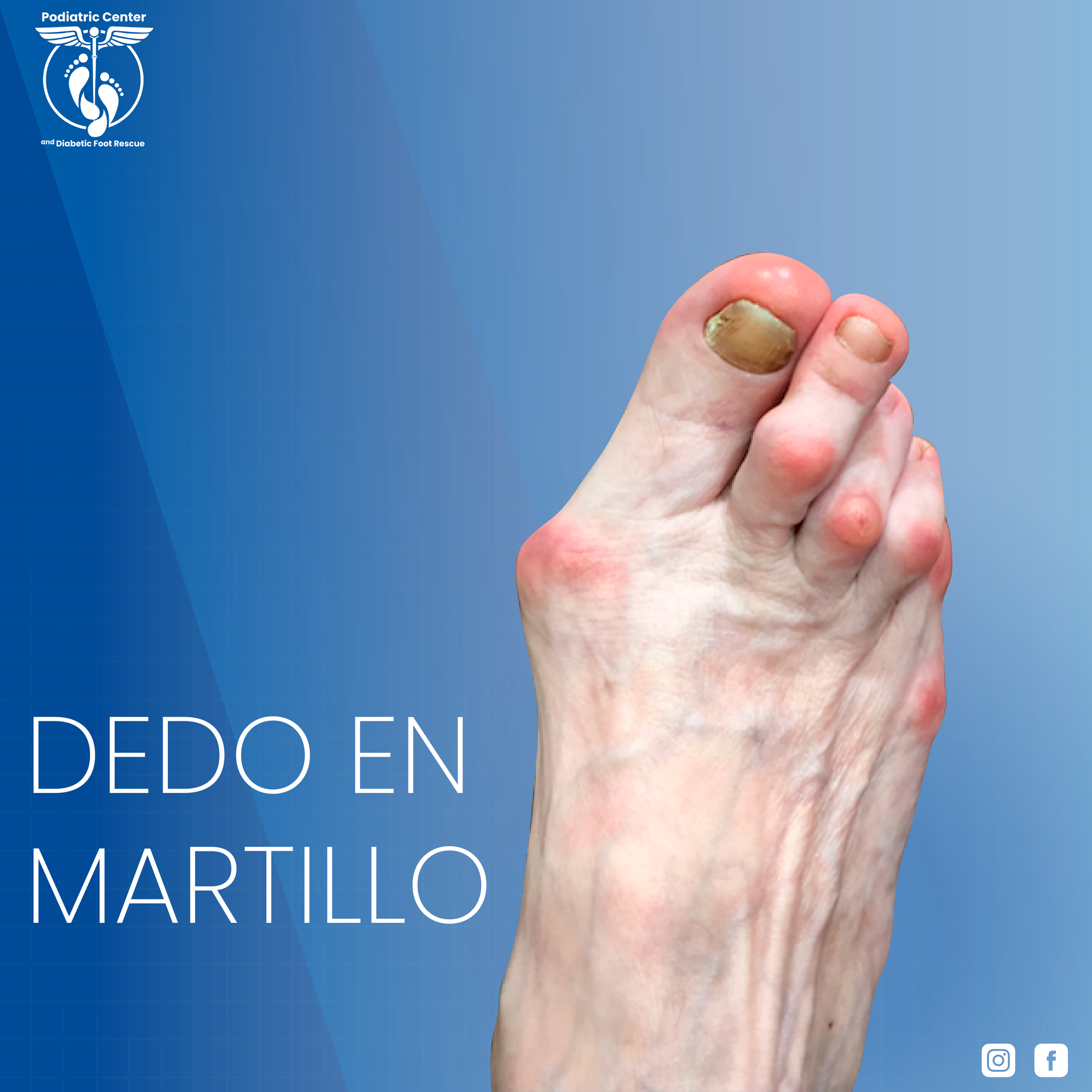 CMP Spa - Es una deformidad que es adquirida al nacer aunque puede ...