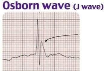 The J Wave (Osborn Wave): J wave, an extra deflection at the QRS