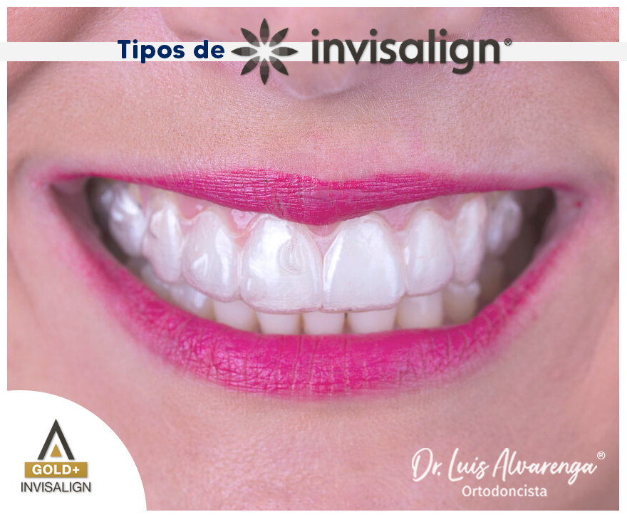 TIPOS DE INVISALIGN® Los... - Dr.Luis Alvarenga.Ortodoncista | Facebook