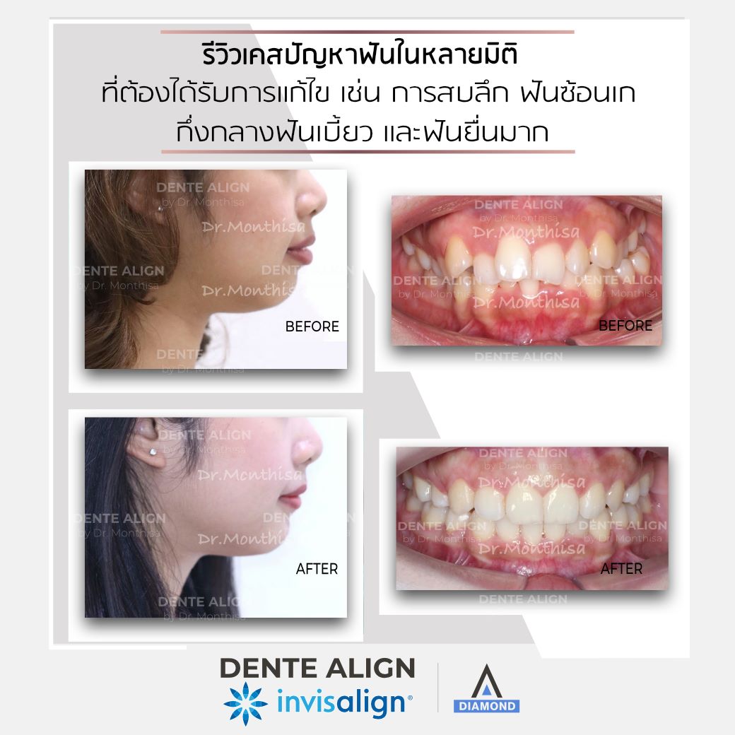 รีวิวเคส... - Dente Align Clinic - Invisalign Diamond Provider | Facebook