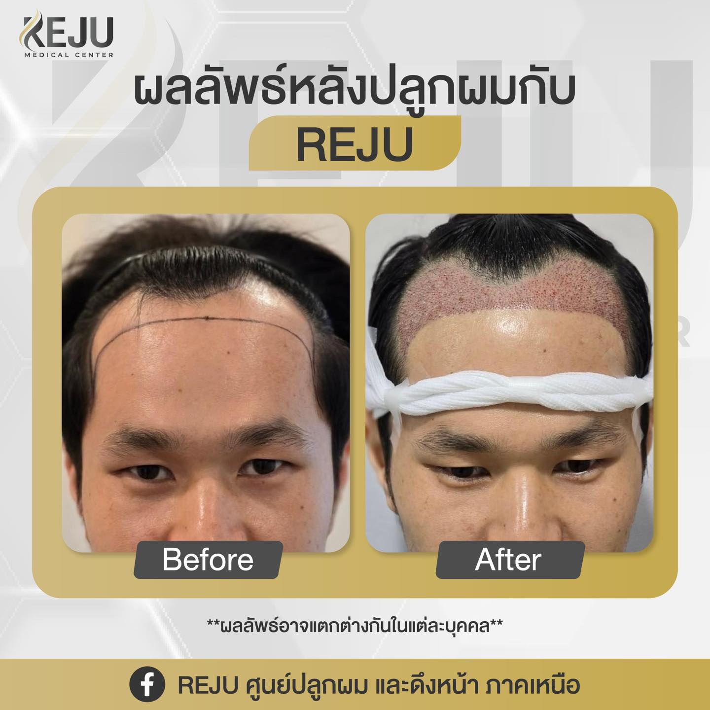 REJU ศูนย์ปลูกผม และดึงหน้า | Bangkok