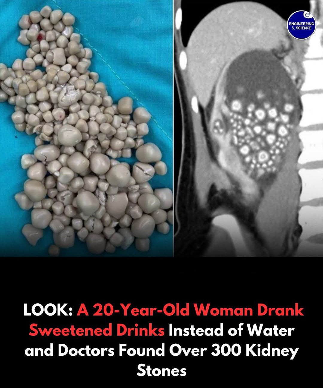 drink water lower bac In Taiwan, a remarkable medical case has drawn global attention—one that highlights the hidden health risks of modern drinking habits. A 20-year-old woman was admitted to hospital with fever and severe lower-back Excel L-Carnitine Body Boosters, b12 injection Size:30 ml x 3