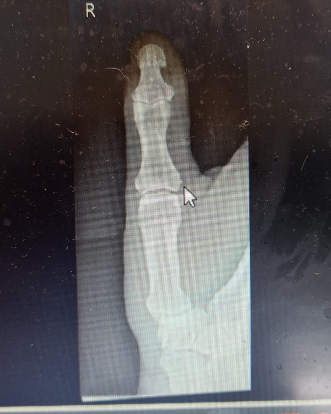 Nick Raschke - I haven’t mentioned this, but I fractured... | Facebook