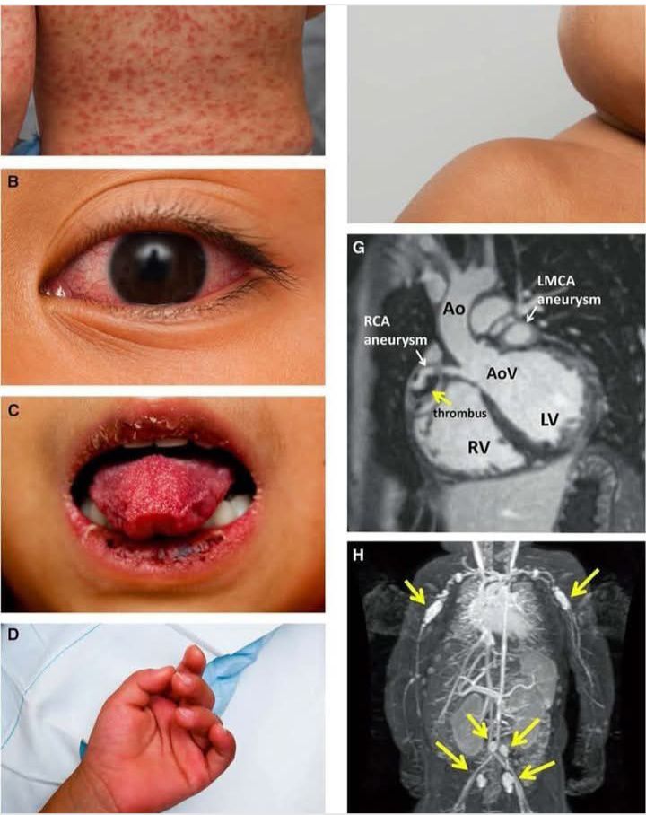 Alicia - KAWASAKI DISEASE Awareness!!! What is KAWASAKI DISEASE? -is a ...
