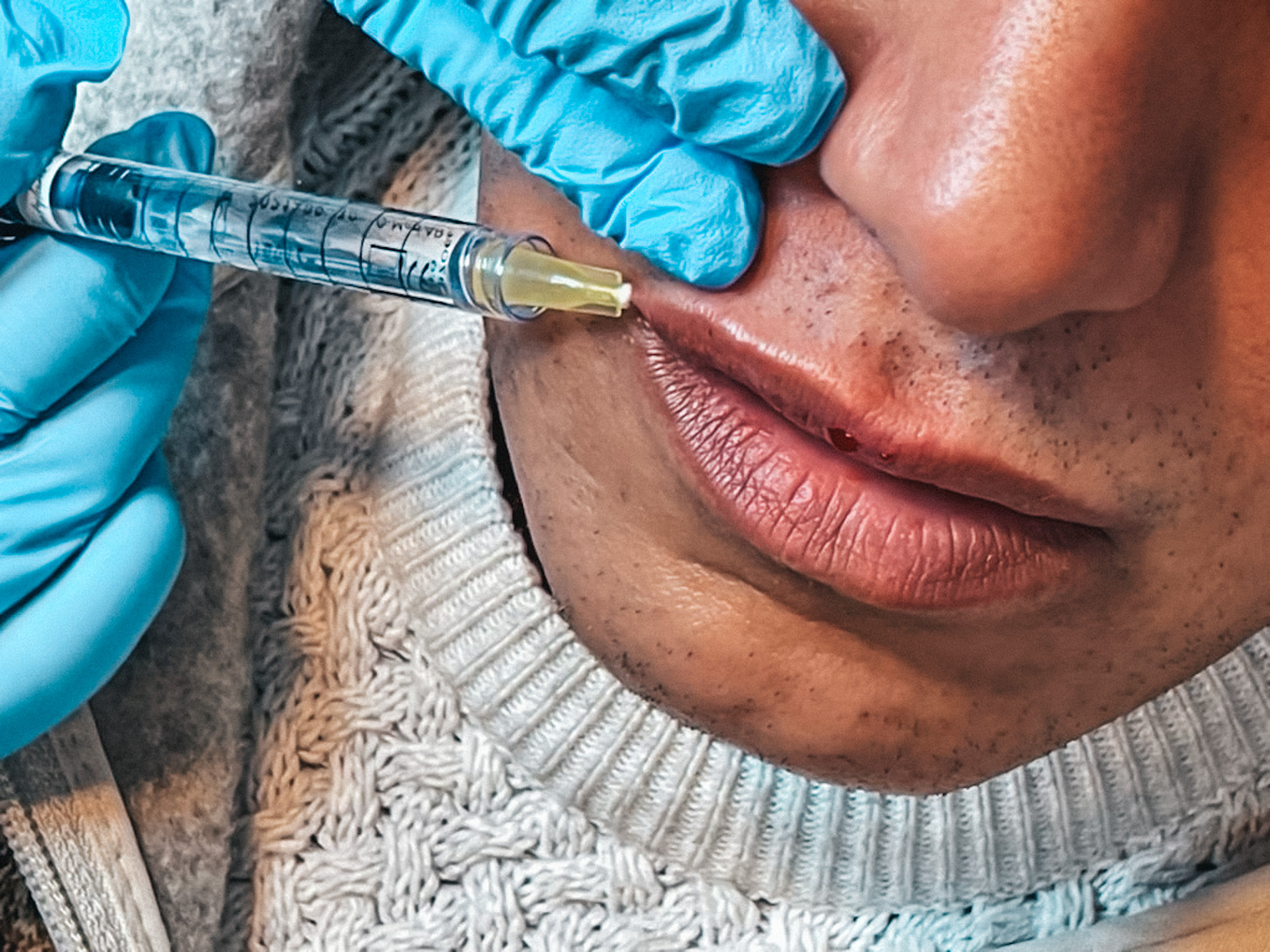 Dr. Rahali - What happens after your injections? 💉 Small... | Facebook