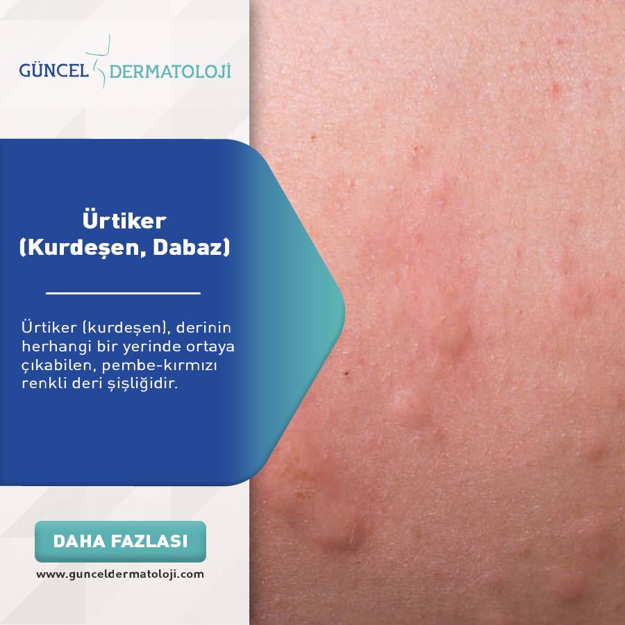 Ürtiker (Kurdeşen, Dabaz) Ürtiker... - Güncel Dermatoloji