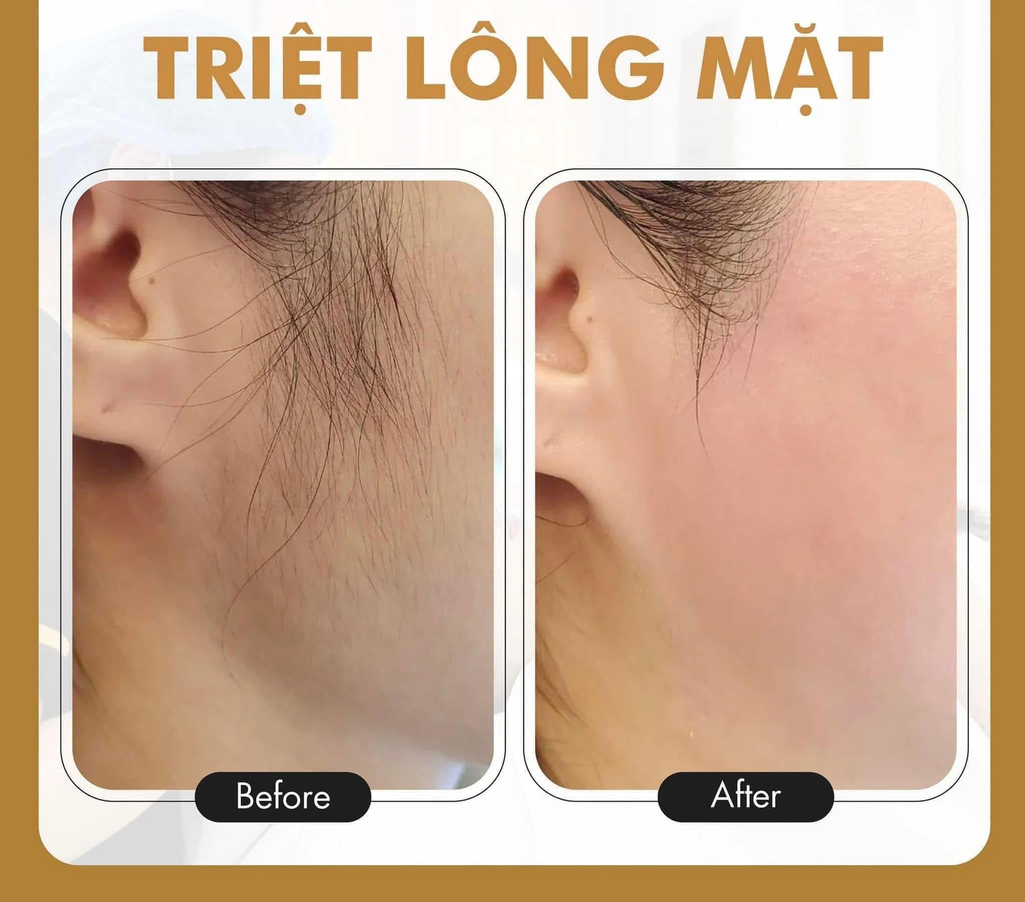 Băng - 💝 𝗚𝗜𝗔̉𝗠 𝗠𝗔̣𝗡𝗛 20%𝗚𝗢́𝗜 𝗧𝗥𝗜𝗘̣̂𝗧 𝗟𝗢̂𝗡𝗚 💝💝 🤫TRIỆT LÔNG MẶT GIÚP DA ...