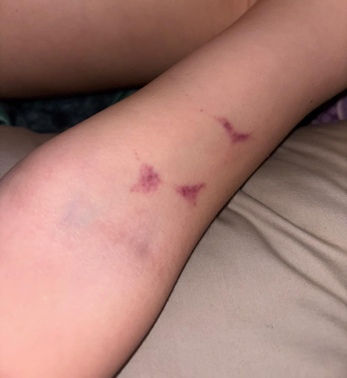 What causes unexplained bruises on a 4-year-old autistic child?