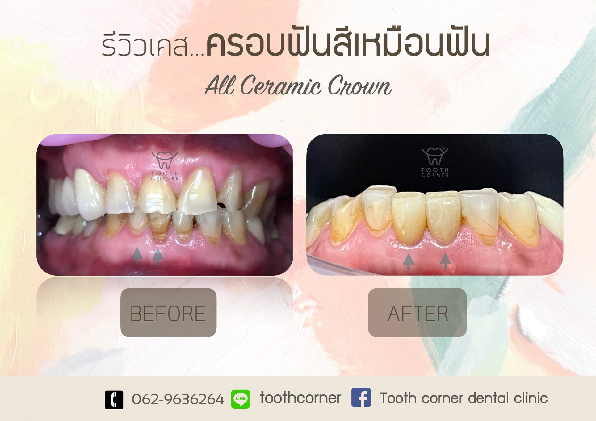 รีวิวเคส...ครอ... - Tooth Corner Clinic - ทูธคอร์เนอะ สหคลินิก