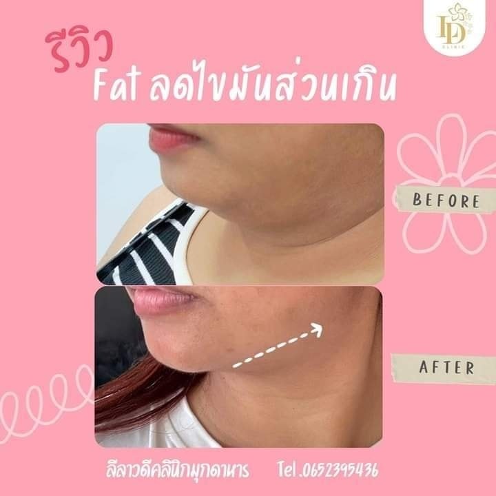 หน้าบาน แก้มใหญ่ เหนียงเยอะแค่ไหนก็เอาอยู่‼️ 