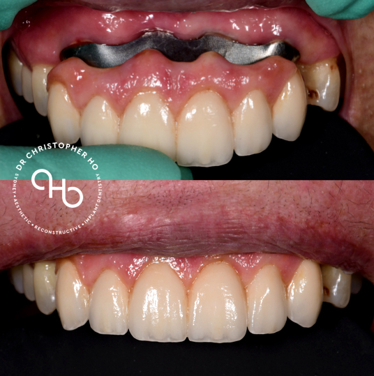Achieving white and pink esthetics in restorative dentistry