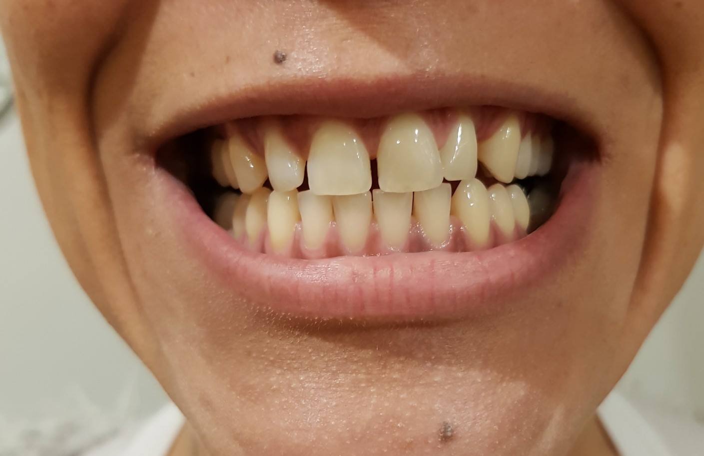 Teeth Whitening Salford, Prestwich, Manchester - Posts ...