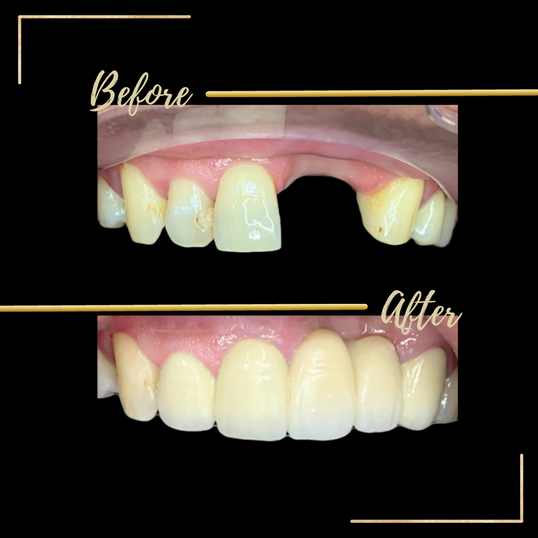 DMP - Porcelain Fused to Metal Crown (PFMC) is a fixed bridge that ...