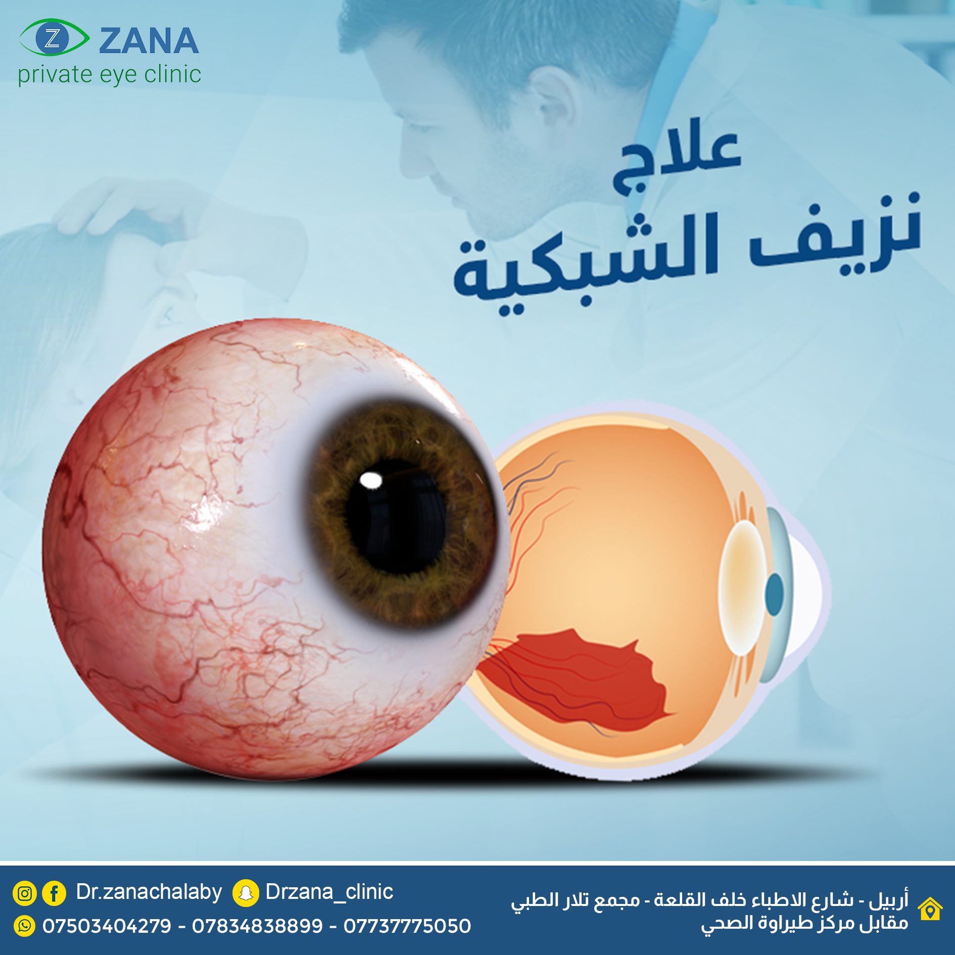عيادة د زانا غني چلبي لعمليات و جراحات العيون والشبكية الأن في عيادة دكتور زانا غني چلبي صار علاج نزيف الشبكية سهل وبسيط جدا دون عناء السفر الى الخارج والتكاليف الباهظة مع توفر أحدث الوسائل