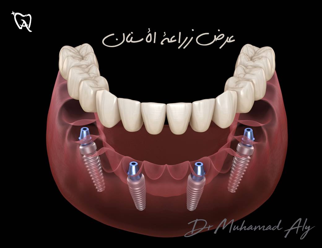 زراعة الأسنان Dental Implant Posts Facebook