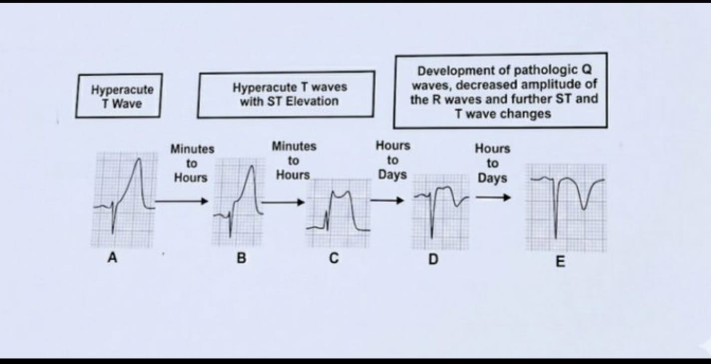 Yahya - the Evolution of a Heart Attack (STEMI) in 5 Stages A ...