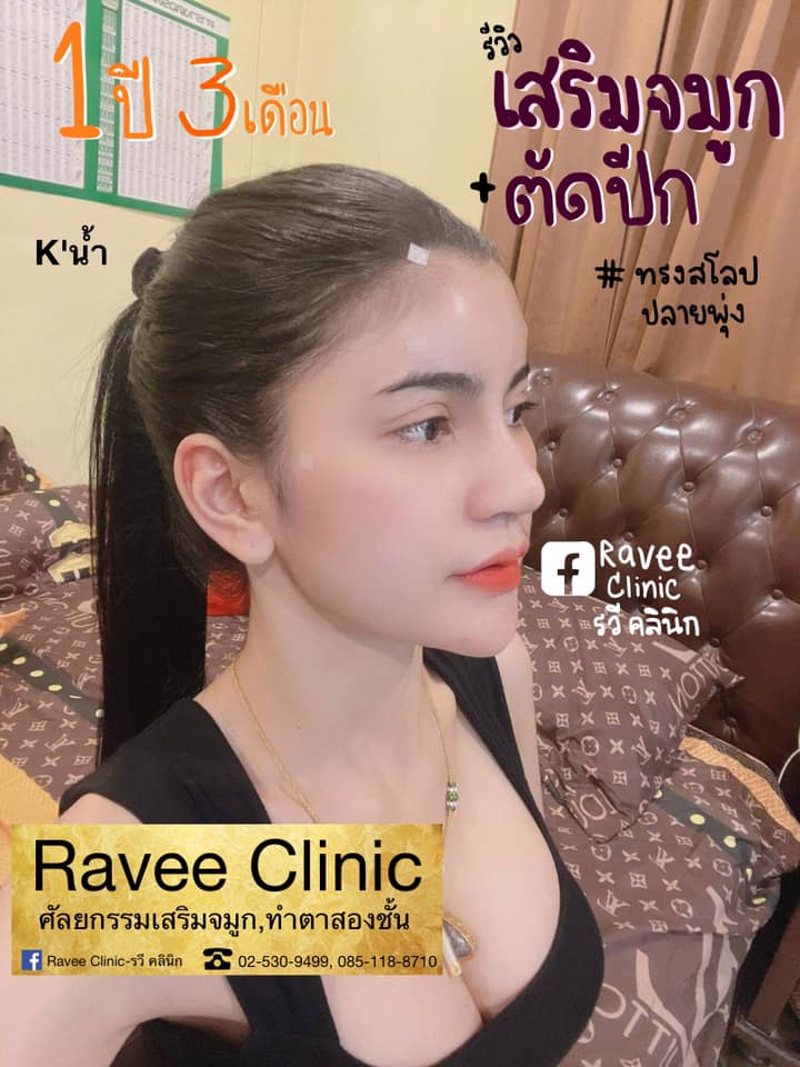 เสริมจมูกใหม่👃🏻