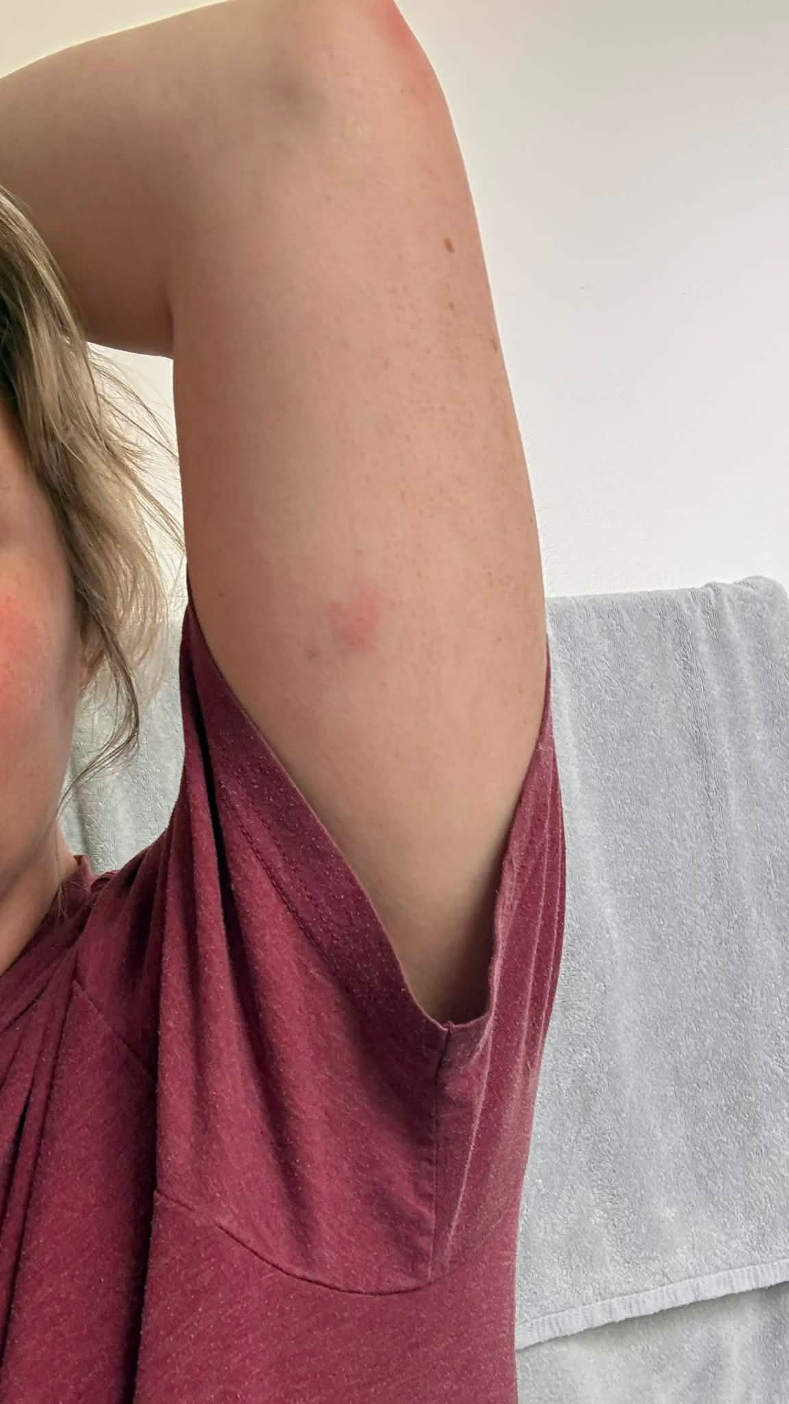 Severe reaction to tirzepatide injection