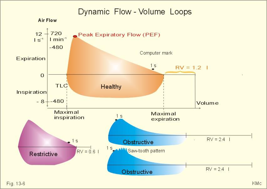 Medicine Libya | A **flow volume loop (FVL)** is a spirometric graph ...