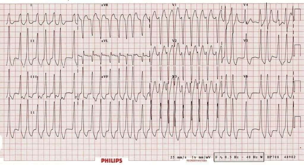 Yahya - #the_classic_ECG_features_in_wpw_synd: A shortened PR interval ...