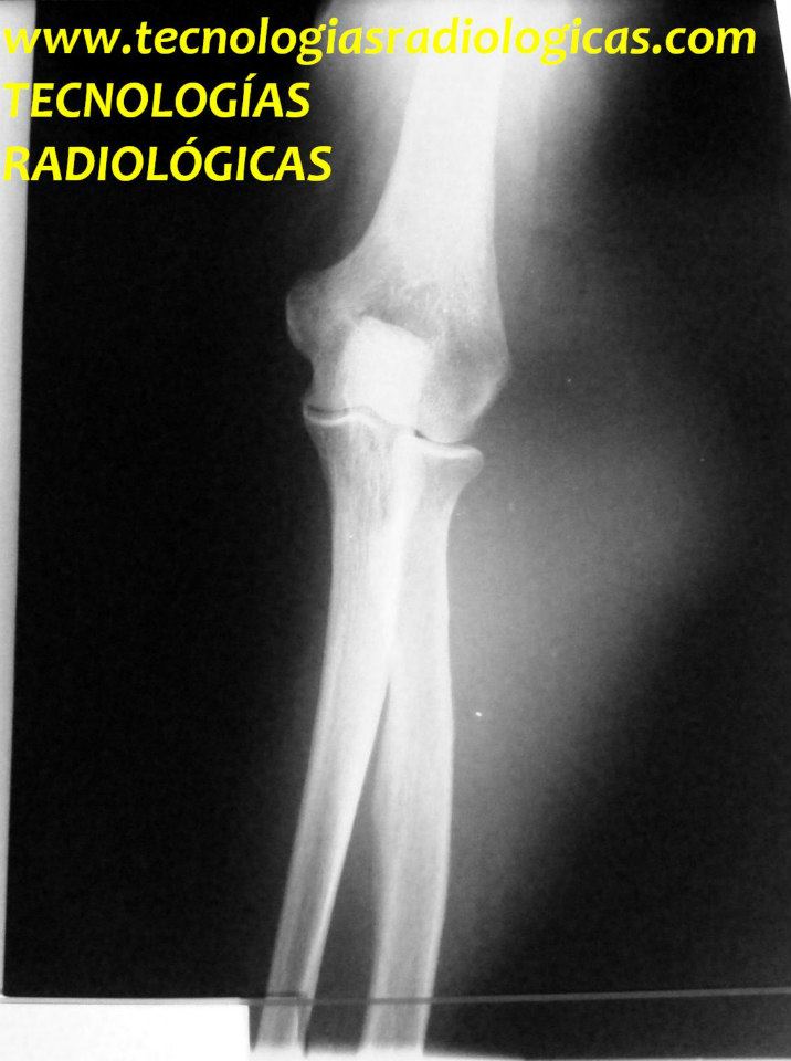 Radiografía De Anatomía Del Codo