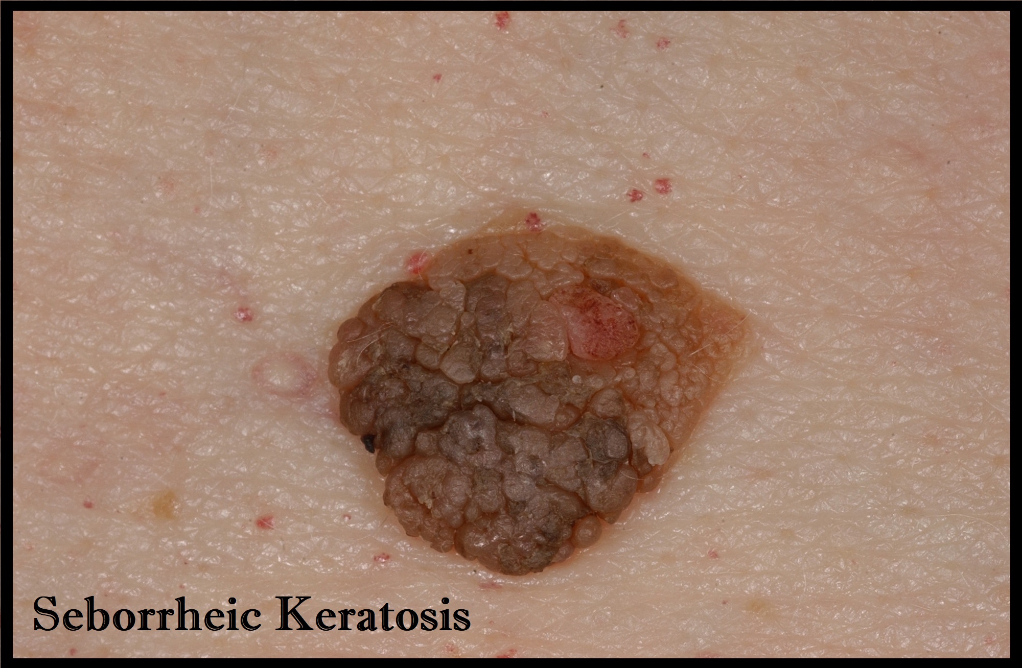 A seborrhoeic keratosis has a rough the laser clinic