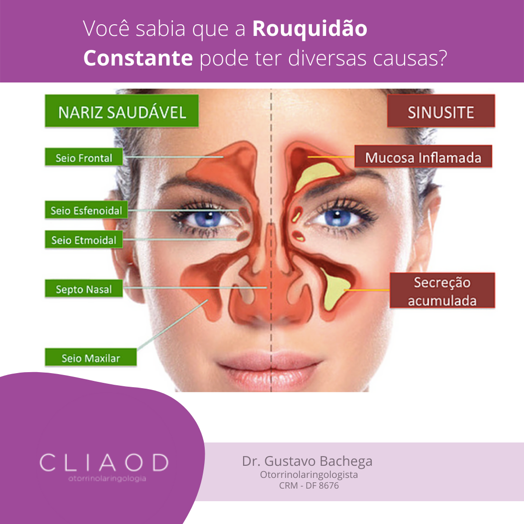 Dr. Gustavo Bachega - Otorrinolaringologista - Sinusite é a inflamação ...
