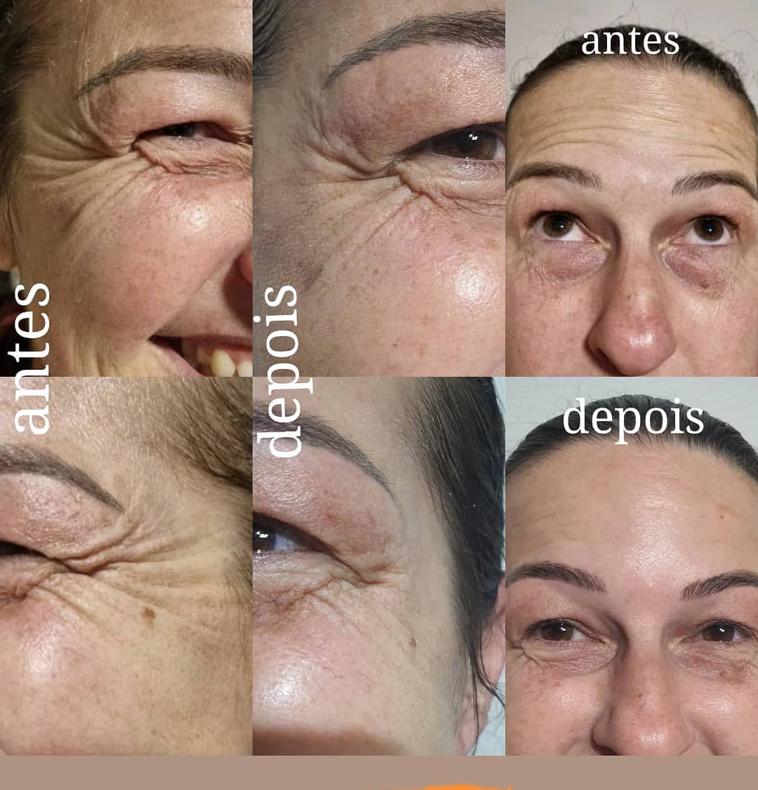 Bárbara Rech - Botox com 40unid Após essas fotos foi...