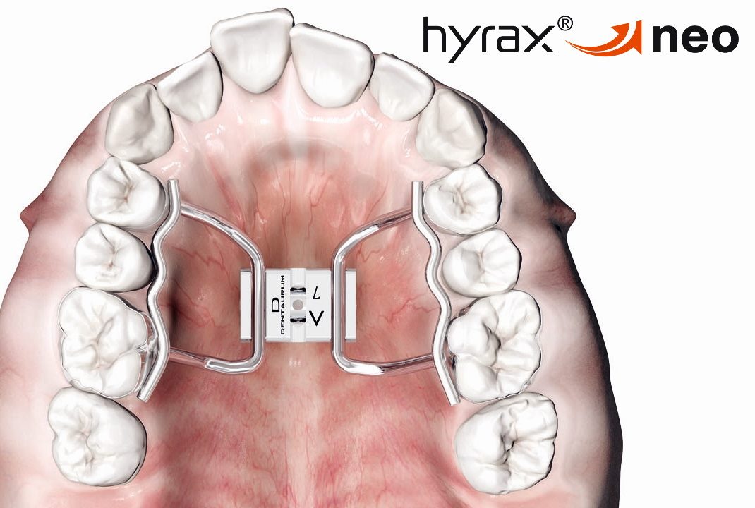 Dentaurum - hyrax® neo - the new Dentaurum RPE screws is now available ...