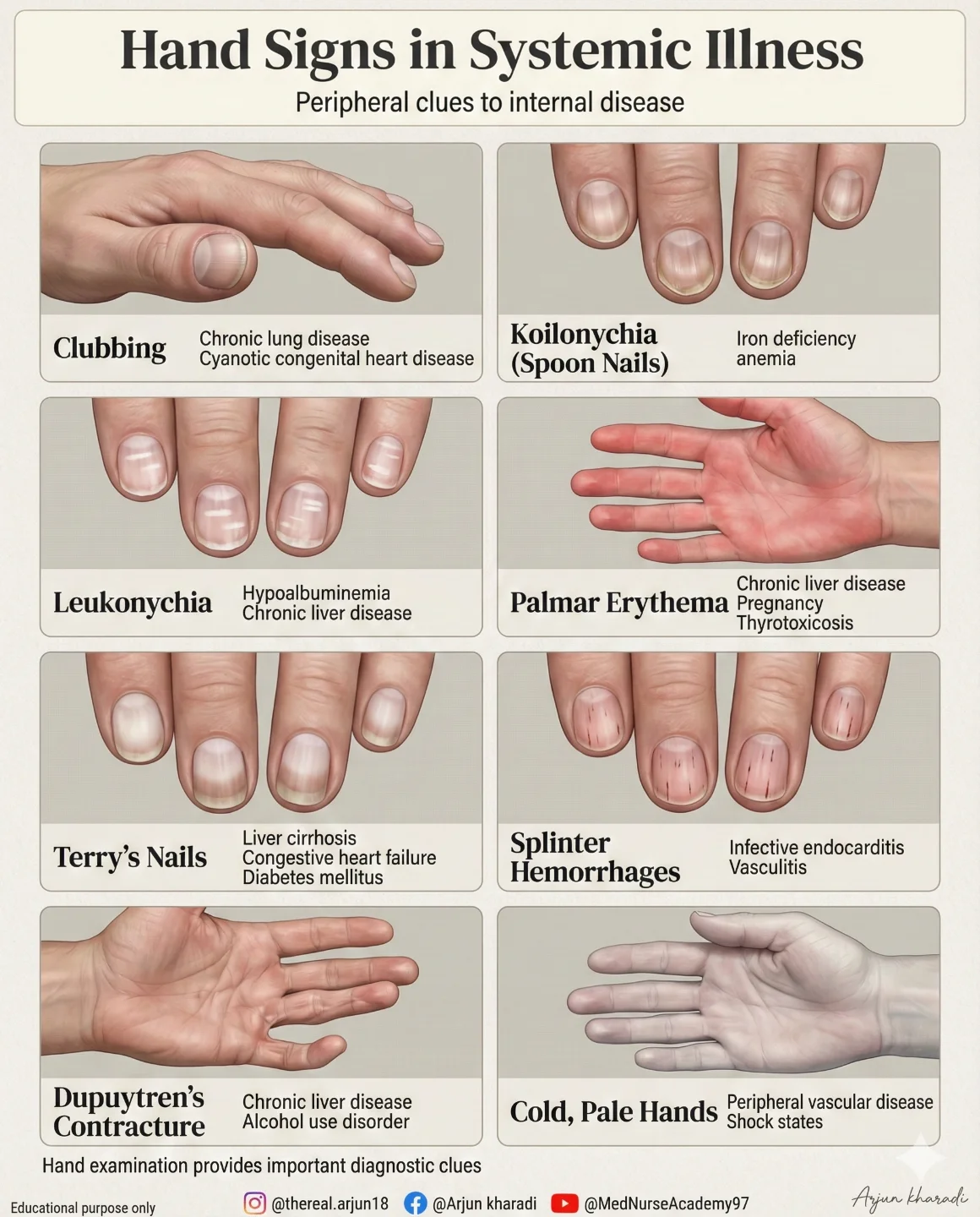 Arjun - Hand signs in systemic illness 🩺 Careful examination of the ...