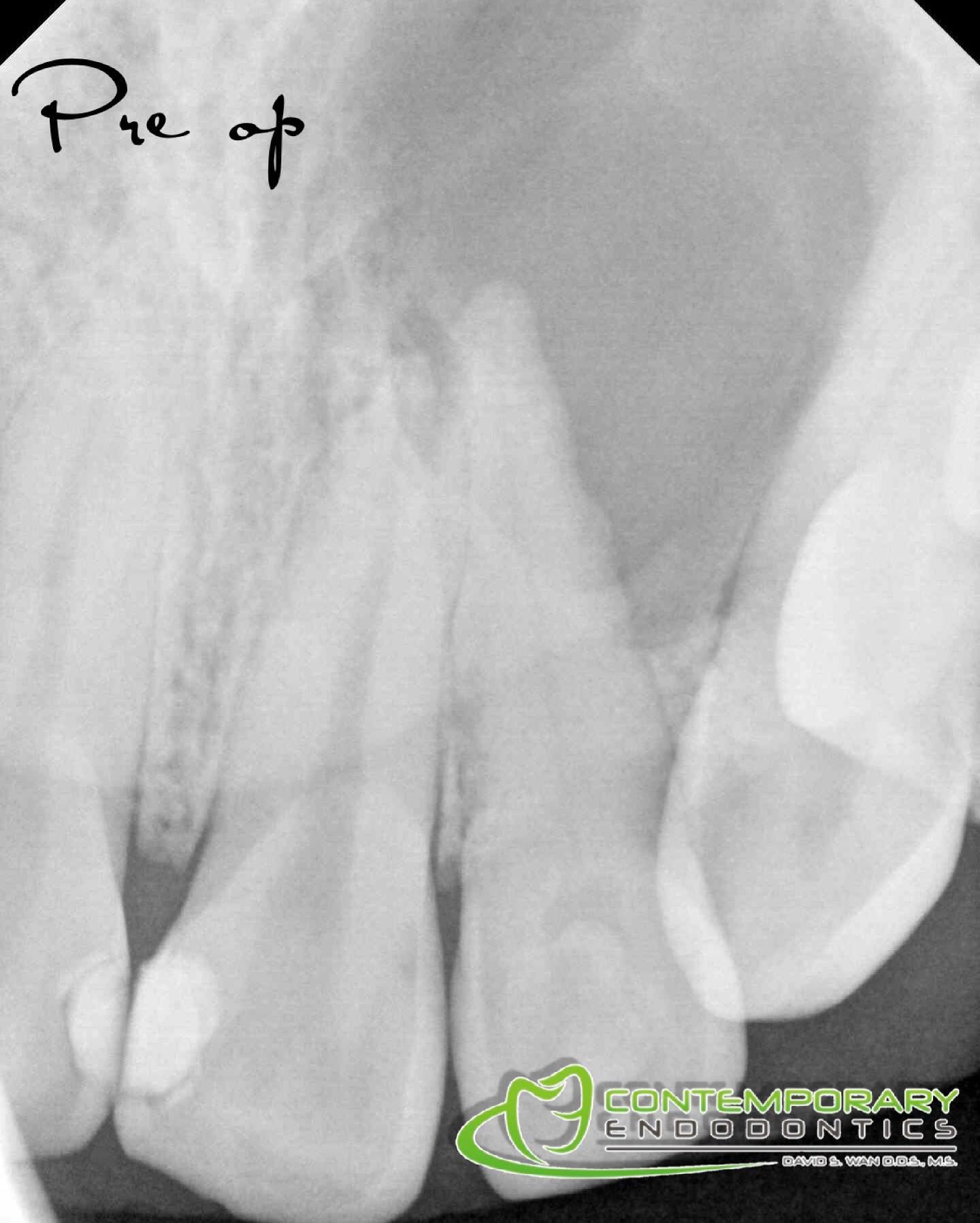 RCT 9,10 dx-pn/caa,... - Contemporary Endodontics Galleria | Facebook