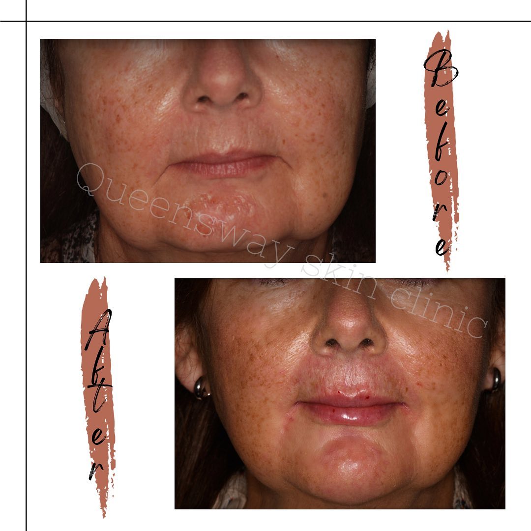 Queensway Skin Clinic - TREATING THE LOWER 1/3RD OF THE FACE The ...