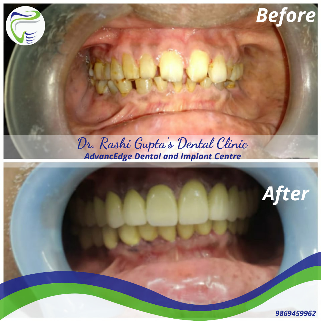 Full mouth restoration and rehabilitation is a complex treatment ...