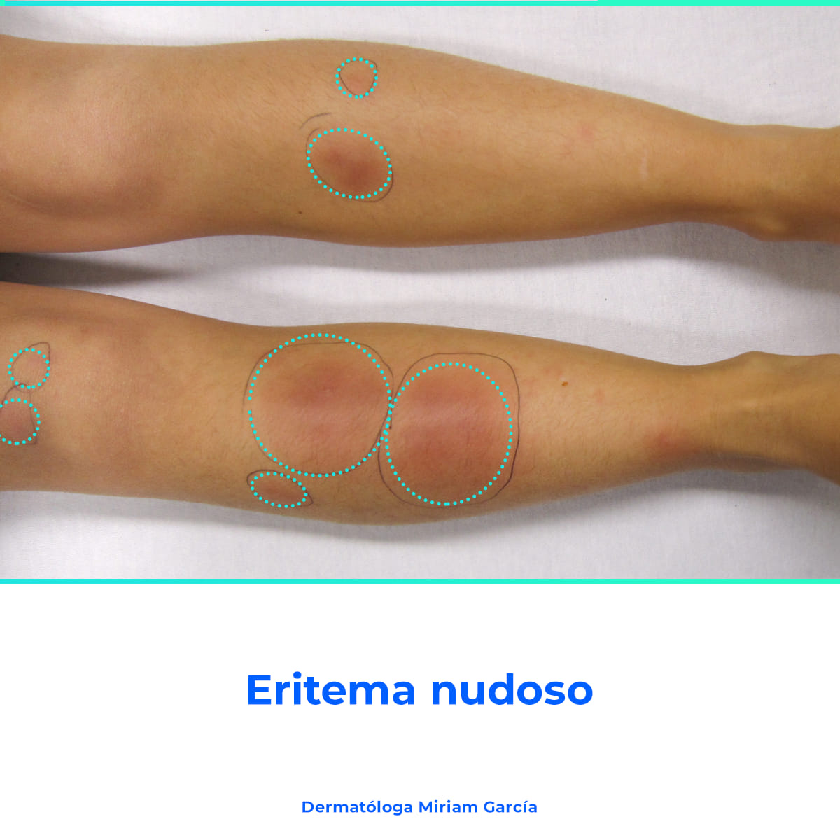 dermat-loga-m-riam-garc-a-eritema-nudoso-es-una-inflamaci-n-del