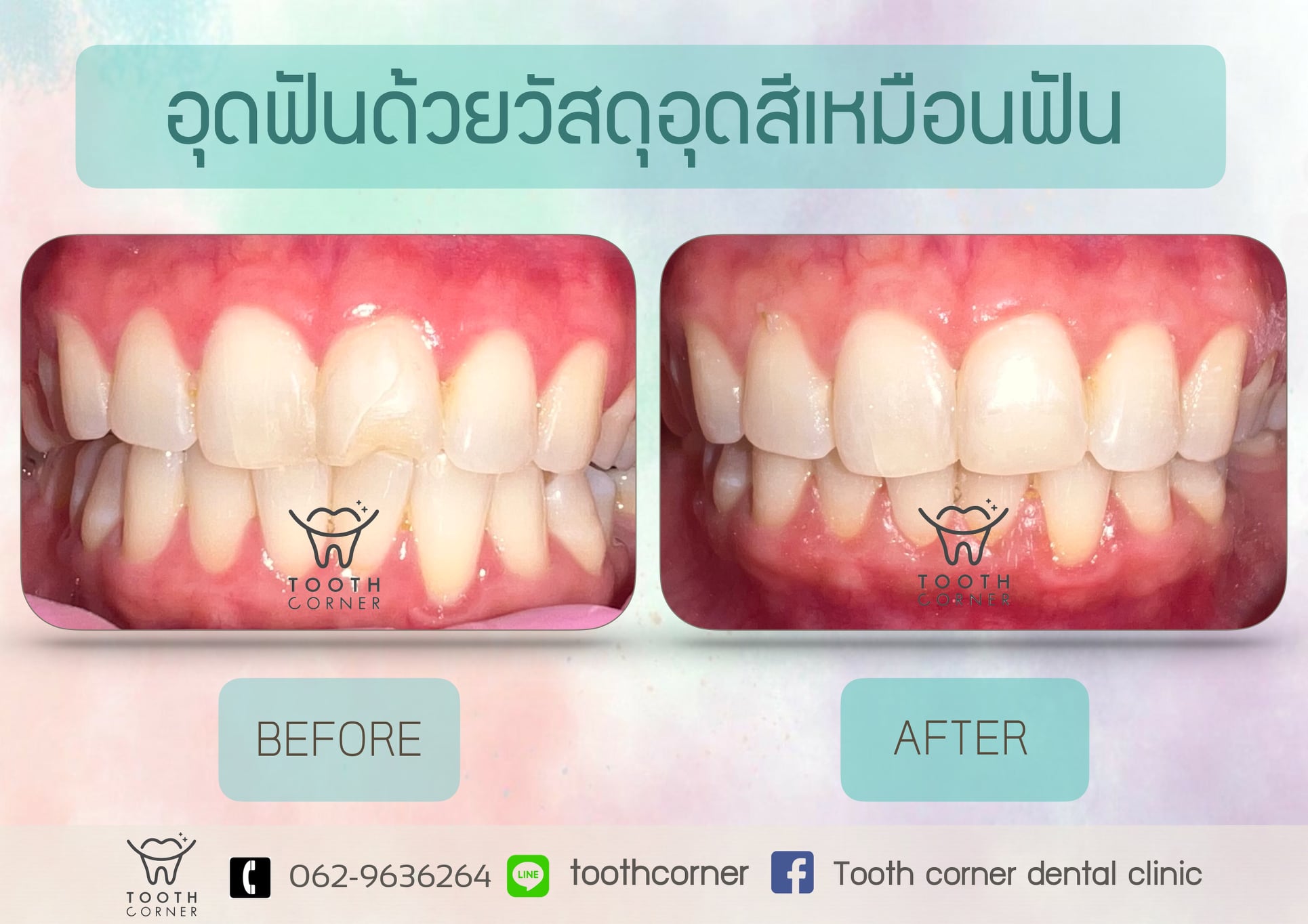 Tooth Corner Clinic - ทูธคอร์เนอะ สหคลินิก - 🎉🎉 รีวิวเคสฟันหน้าบนขวา ...